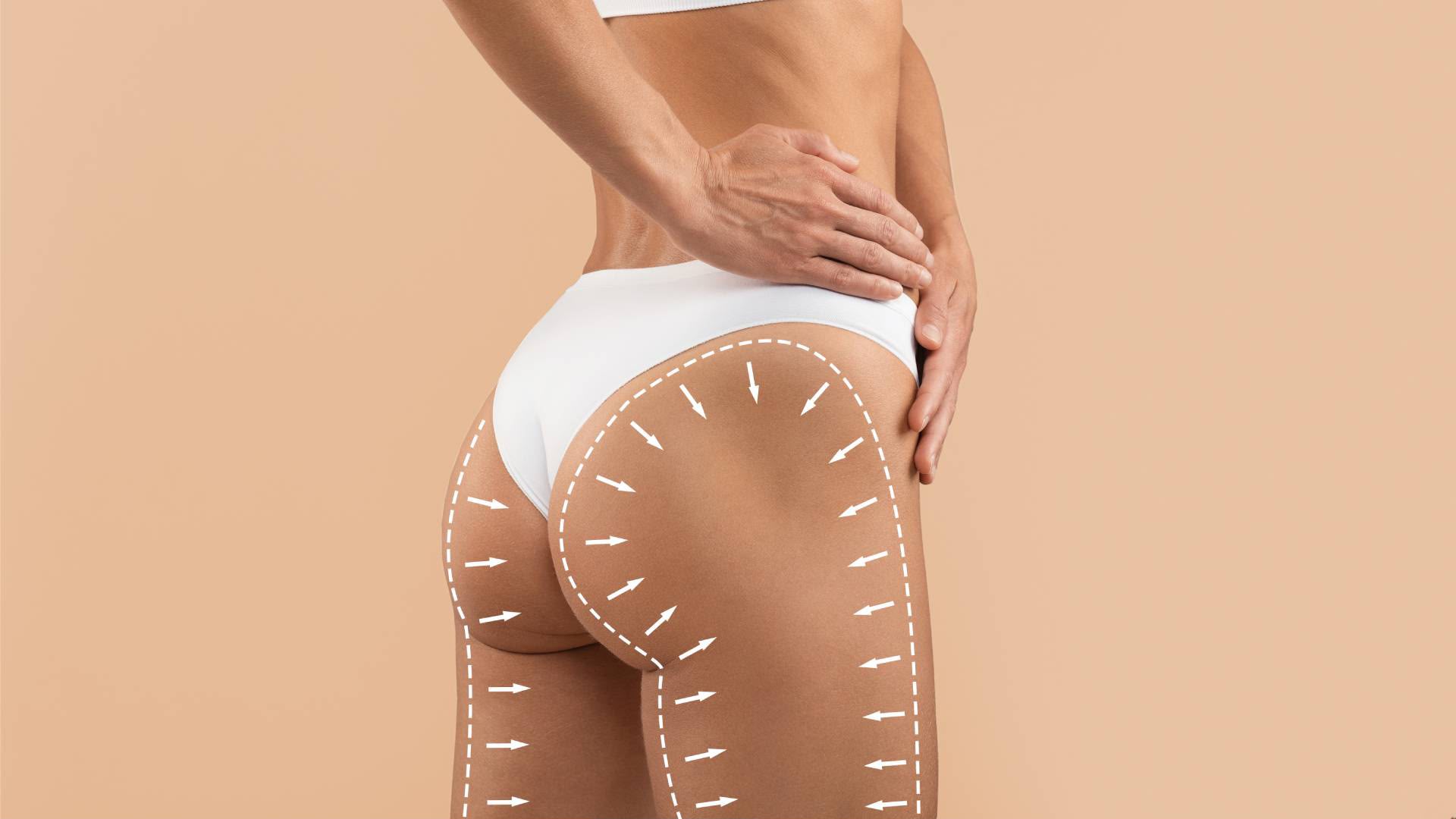 Brazilian Butt Lift (BBL) im EsteCenter Istanbul