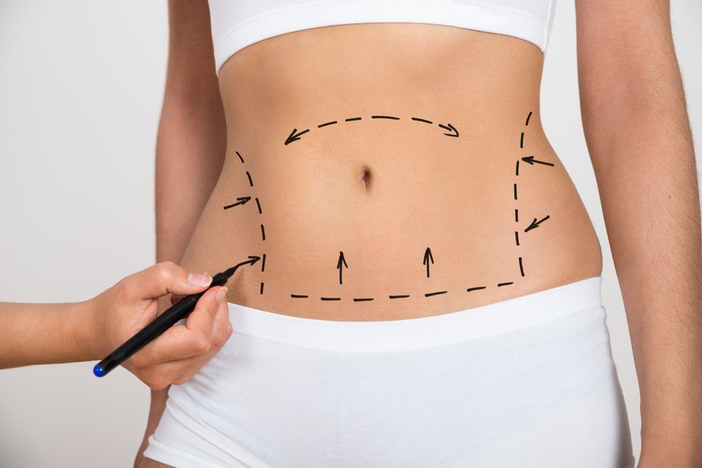 Bauchdeckenstraffung (Abdominoplastik) im EsteCenter Istanbul