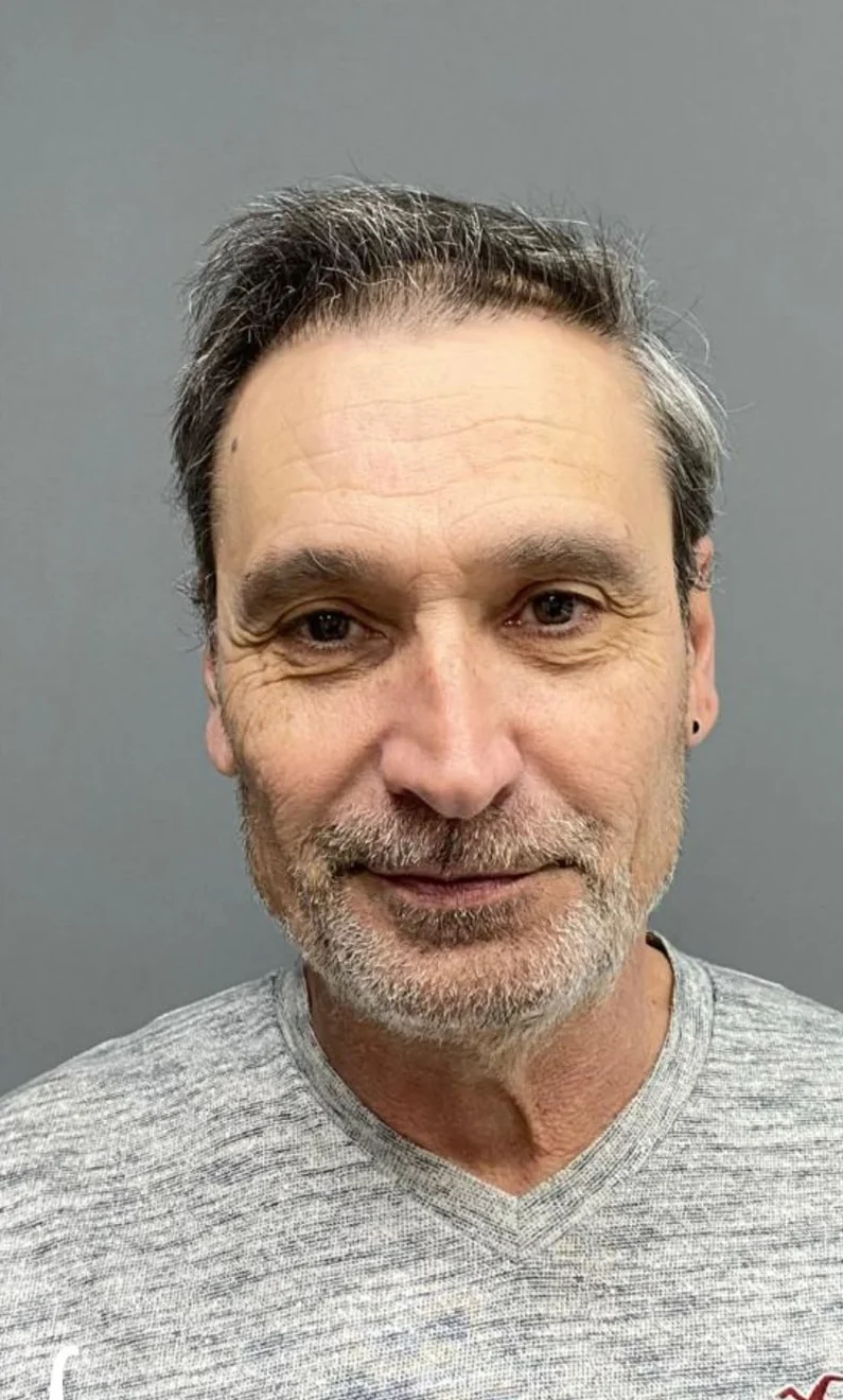 Ergebnis nach Haartransplantation
