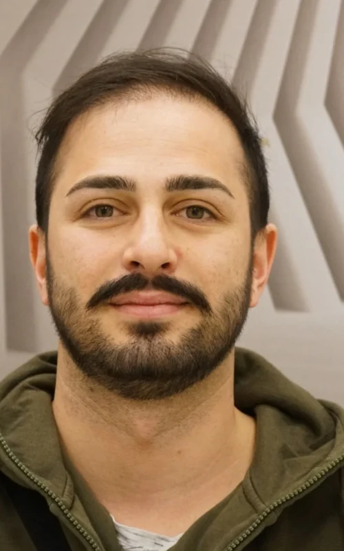 Vor der Haartransplantation