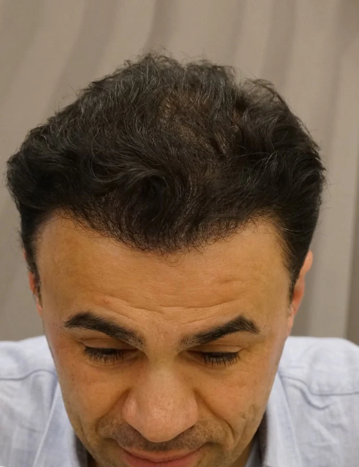 Ergebnis nach Haartransplantation