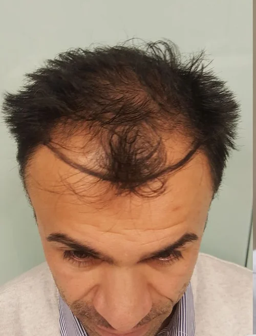 Vor der Haartransplantation