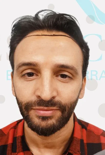 Vor der Haartransplantation