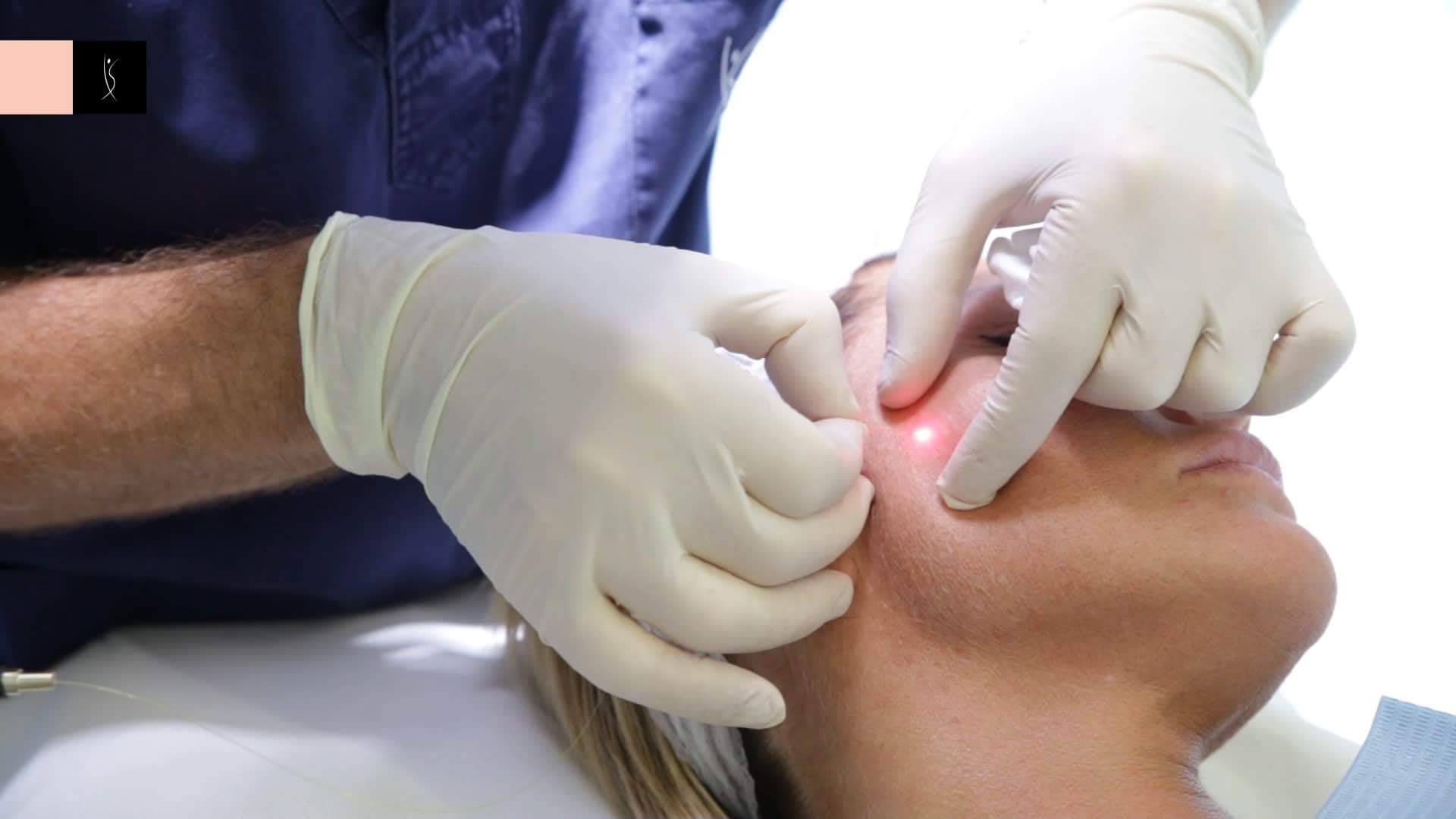 Endolift Laser-Facelift bei EsteCenter Istanbul