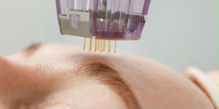 Goldene Nadel Scarlet X Radiofrequenz-Microneedling bei EsteCenter Istanbul