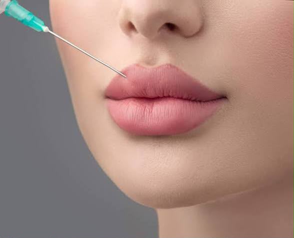 Lippenfiller-Behandlung bei EsteCenter Istanbul