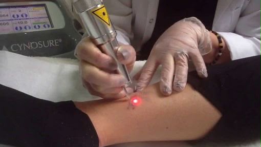 Mydon Laser-Hautbehandlung bei EsteCenter Istanbul