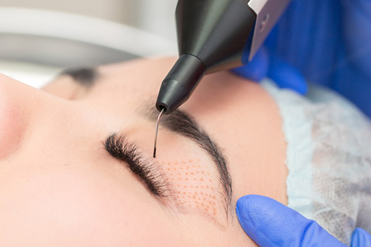 Plexr Plasma-Soft-Surgery bei EsteCenter Istanbul