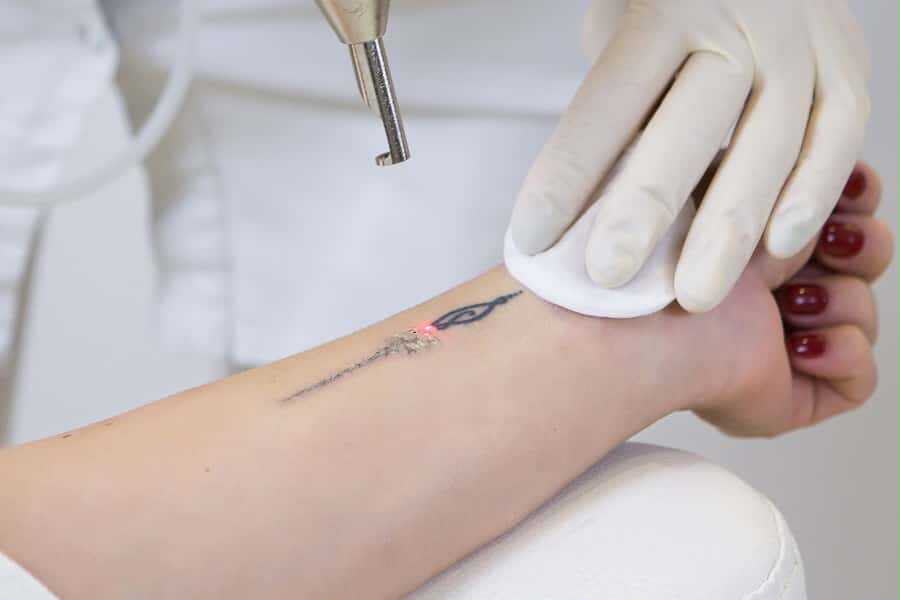 Laser-Tattooentfernung bei EsteCenter Istanbul